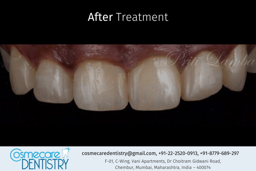 After the treatment we at Cosmecare Dentistry fixed the Gaps and Food Lodgement problem of the Patient at Dental Clinic in Chembur