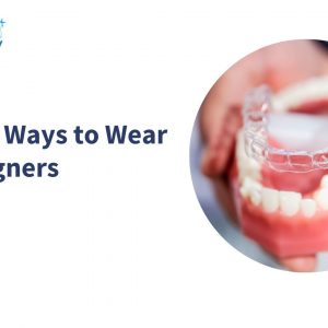 how to wear clear aligners - image showing a graphic of clear aligners