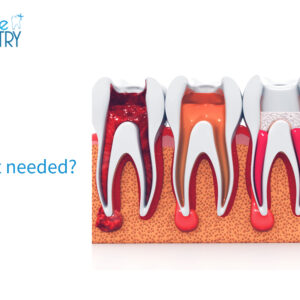 Root Canal Treatment Chembur